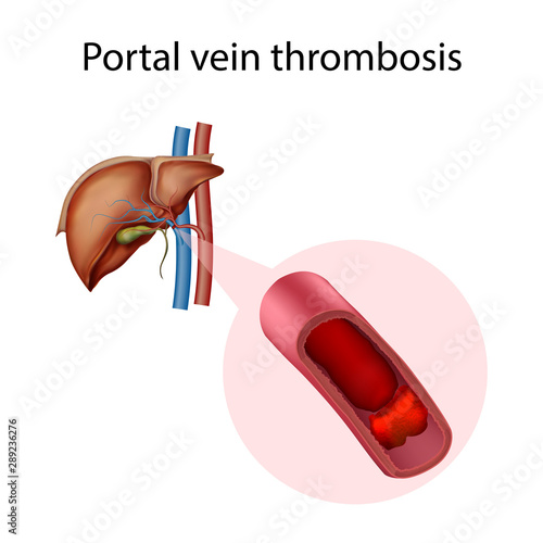 Portal vein thrombosis. Vector medical anatomy illustration.