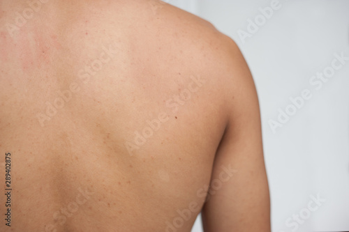 Acne skin. Acne skin on the back. Human skin.