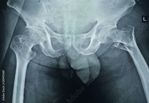 Photography X-ray both hip : A male 68 year old fracture left Neck of femur ( Thigh bone )