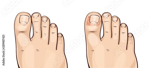 Foot herpes infections, medical illustration  