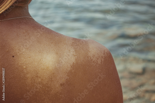 Photo The girl's sunburned shoulder