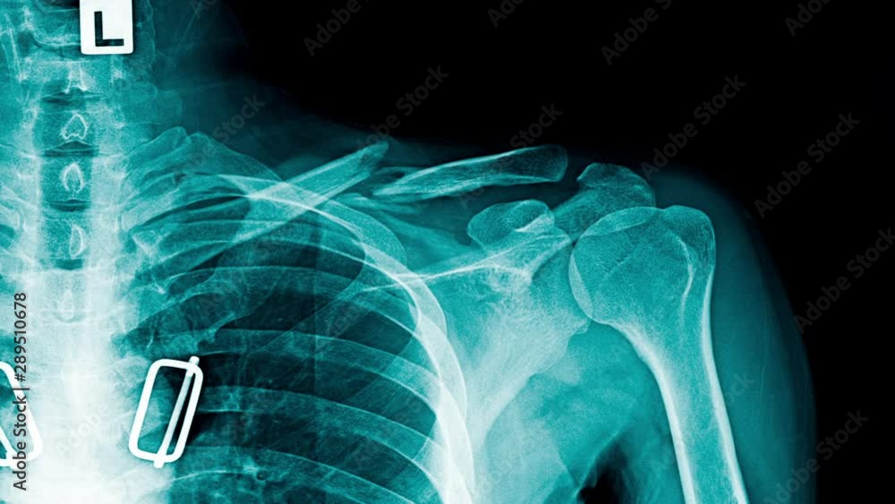 shoulder pain xray footage with red hight light on shoulder joint