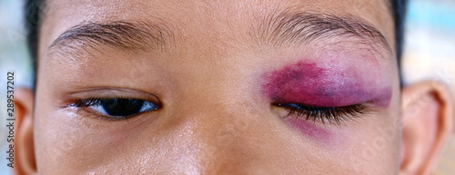 Close-up of bruised eye of asian boy, black and blue wound hurt from accident. photo