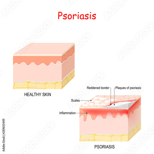 normal skin and psoriasis.