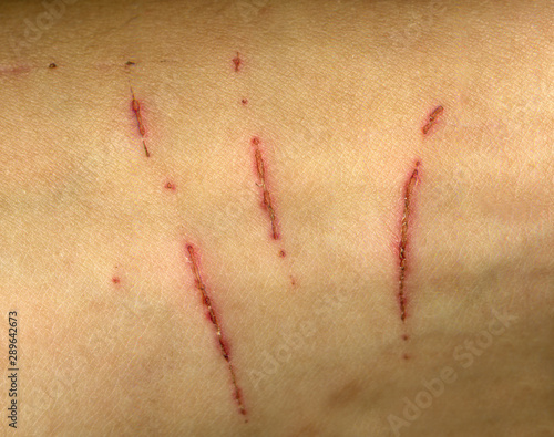 cat scratch skin, claw mark