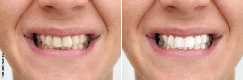 Obraz premium Teeth of a woman before and after correction and whitening