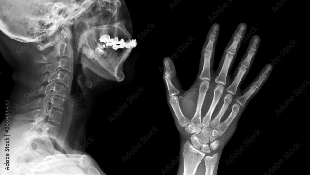 Film X ray radiograph show anatomy of human bone skull, cervical spine, skeletal and hand skeleton. medical imaging and radiology concept Film X ray radiograph show anatomy of human bone skull, cervical spine, skeletal and hand skeleton. medical imaging and radiology concept