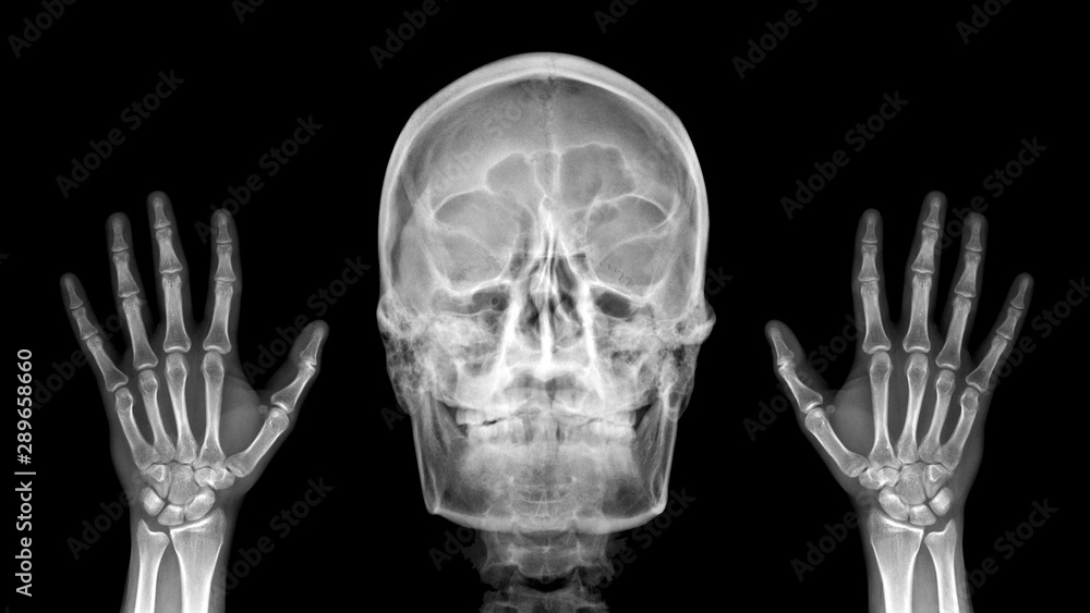 BONES Portrait X-ray Marker Parker for Radiology Technologist (multicolor  skull) - Yahoo Shopping