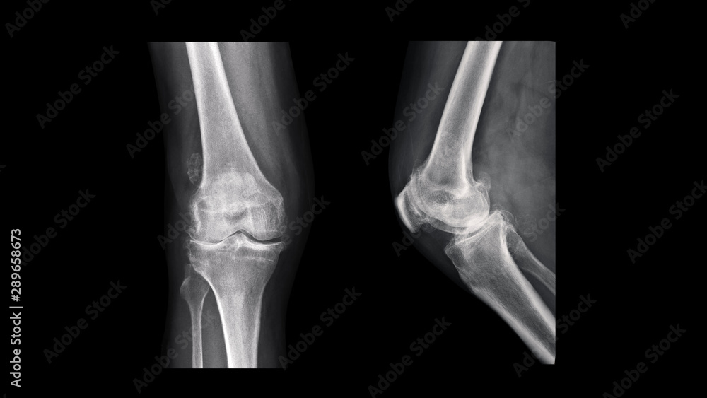 xray of a hand xray of a hand