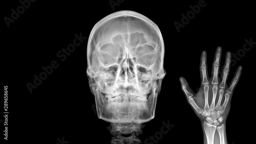 Film X ray radiograph show human anatomy of skull bone and skeleton which skeletal hand show sign of saying Hello. Medical imaging in orthopedic and radiology concept