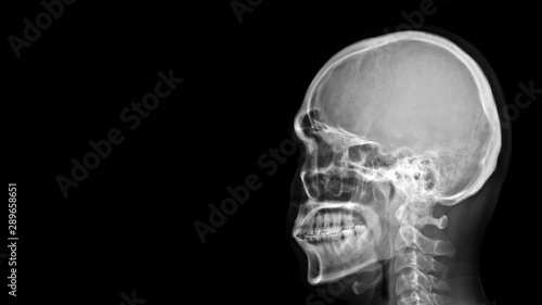 Film X-ray radiograph show human anatomy of bone skull, cervical spine and skeleton with free black space background.  Medical imaging in neurology and radiology concept 