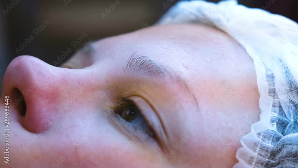 Mechanical cleaning of the face at the beautician. Cosmetologist squeeze the acne on the forehead of the patient with medical needle Mechanical cleaning of the face at the beautician. Cosmetologist squeeze the acne on the forehead of the patient with medical needle