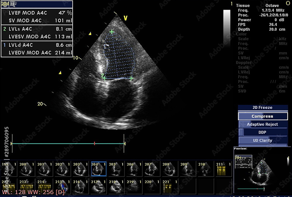 Screen of echocardiography (ultrasound) machine. Stock Photo | Adobe Stock