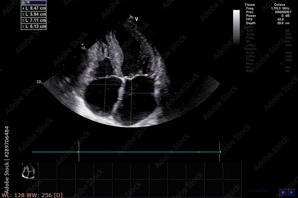Screen of echocardiography (ultrasound) machine. Stock Photo | Adobe Stock