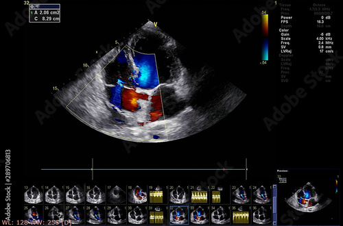 Screen of echocardiography (ultrasound) machine.