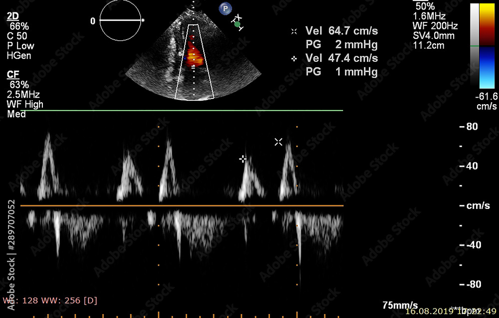 Screen of echocardiography (ultrasound) machine. Stock Photo | Adobe Stock
