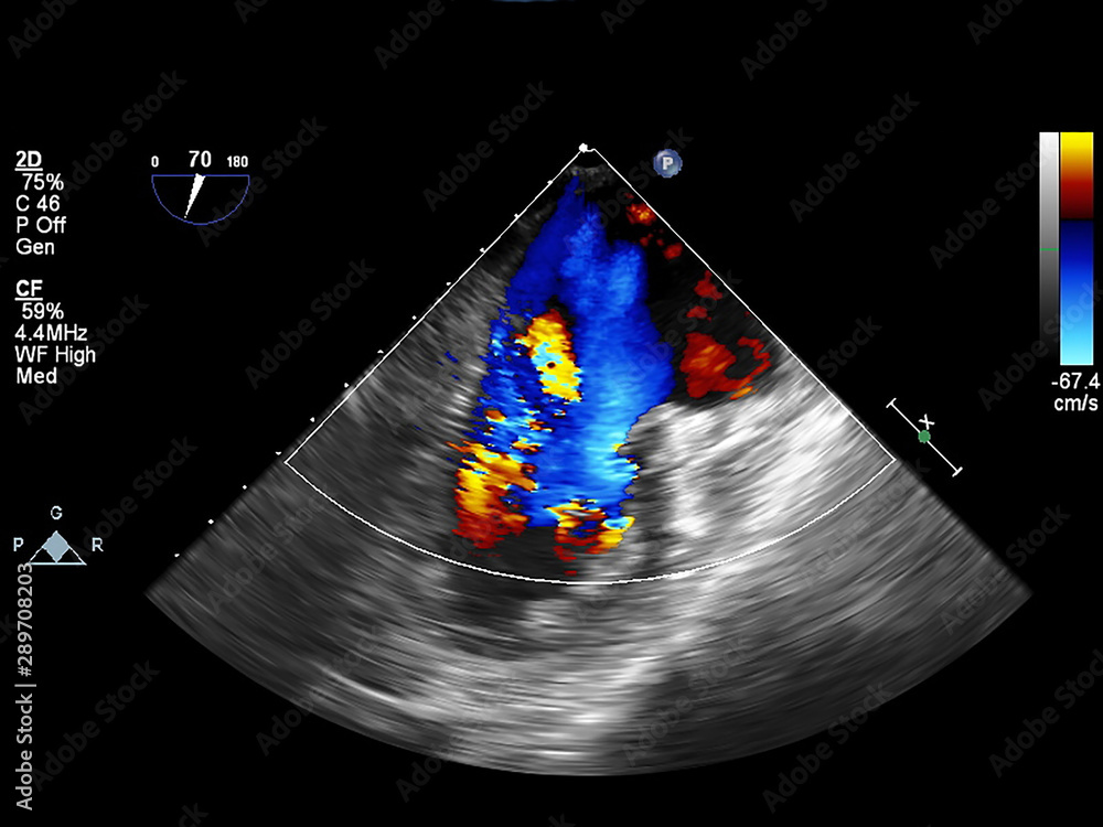 Screen of echocardiography (ultrasound) machine. Stock Photo | Adobe Stock