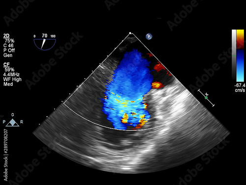 Screen of echocardiography (ultrasound) machine.
