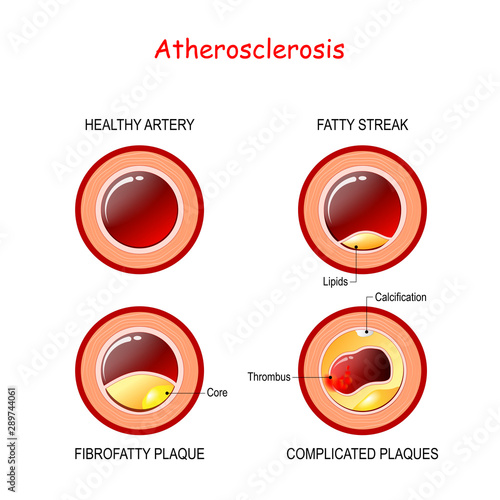 stages of atherosclerosis. Cholesterol in artery