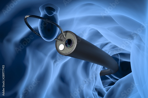Tapety artystyczne endoscope remove colonic polyp