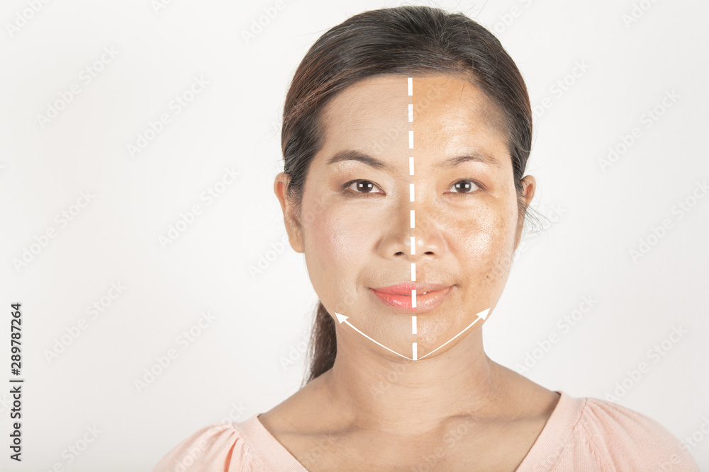 before and after spot melasma dark and freckles facial treatment on face asian woman. and skin Problem before and after spot melasma dark and freckles facial treatment on face asian woman. and skin Problem