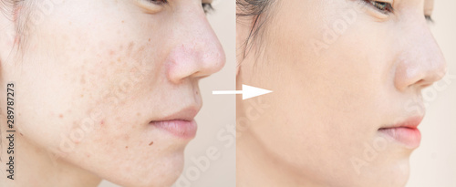 Before and After Retouch face and  Freckles  Woman  and skin problems  Facial Treatment Step
