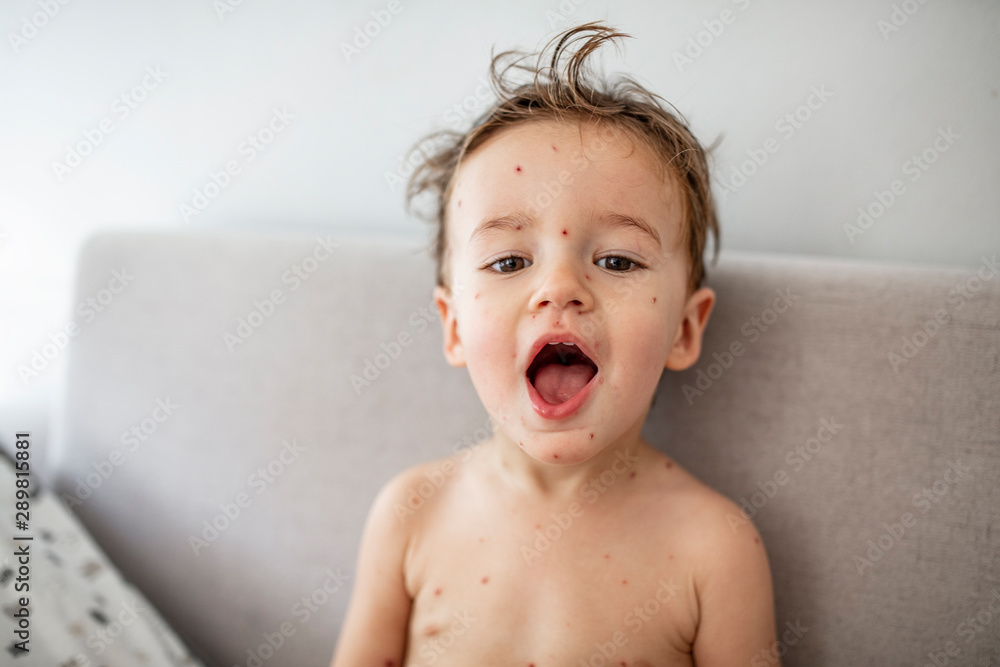Young toddler with chickenpox. Sick child with chickenpox. Varicella