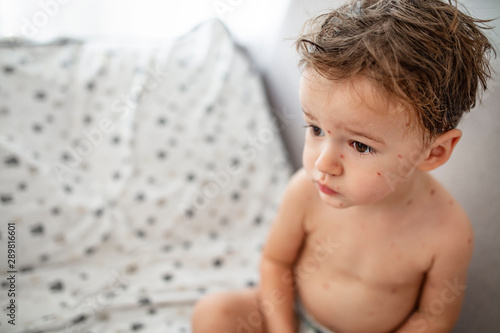 Fotografie Child with spotted skin