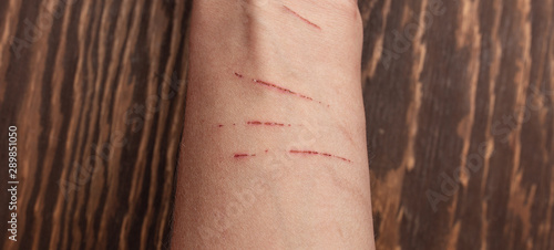 cat scratches on skin