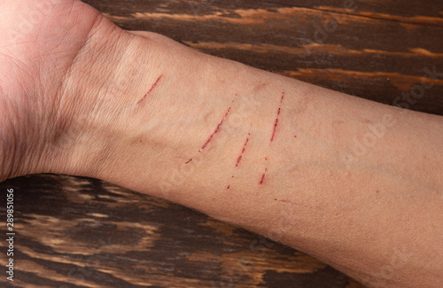cat scratches on skin