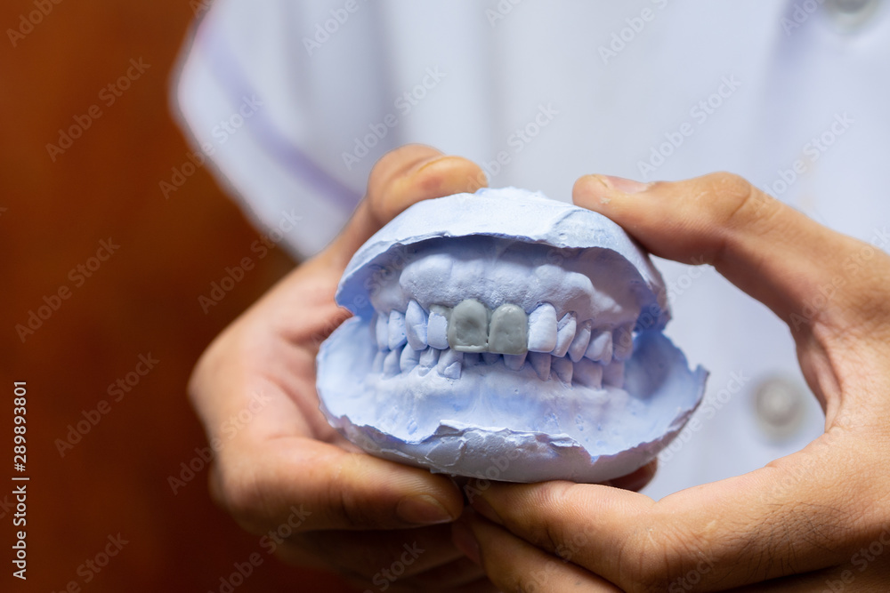 Teeth mold dental veneers - Front view Stock Photo