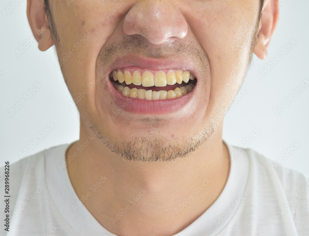 Close-up of yellow dirty teeth in male from smoke and coffee Close-up of yellow dirty teeth in male from smoke and coffee