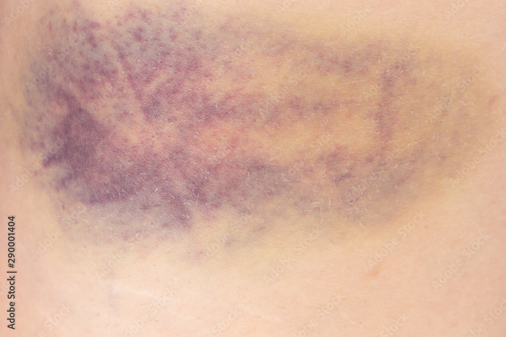 Fototapeta premium Hematoma on a woman thigh after a bruise or contusion