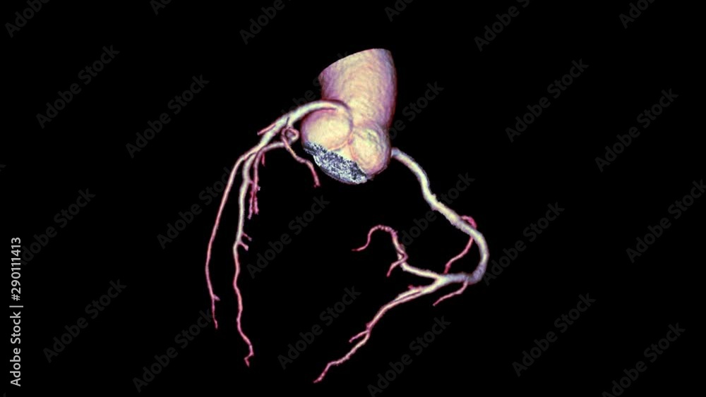 CTA Coronary artery 3D rendering image or coronary tree turn around on ...
