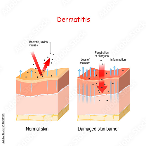 Dermatitis. Normal and skin with Damaged barrier. protection effect
