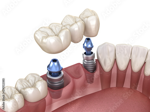 Dental bridge supported by implants. Medically accurate 3D illustration of human teeth and dentures concept