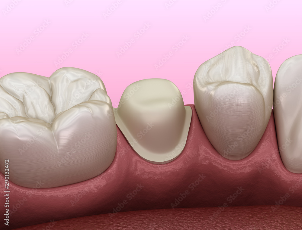 Preparated premolar tooth for dental metalceramic crown placement