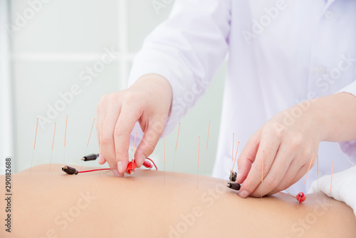 Close up of acupuncturist hands doing acupuncture with electrical stimulator at patient back ,Alternative medicine concept.