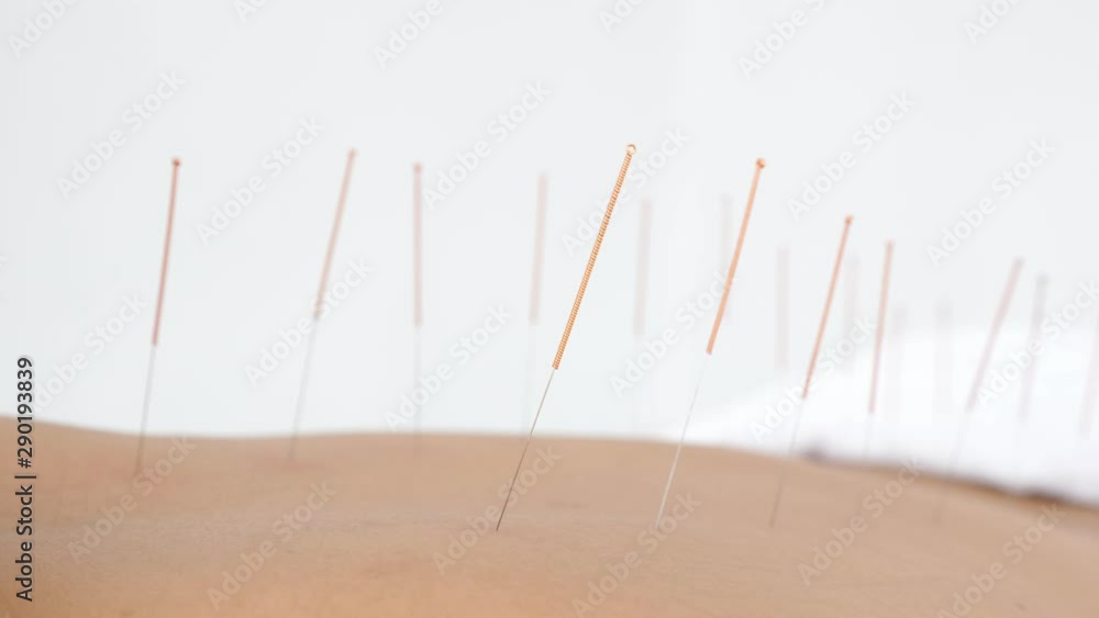Row of needles on patient back moving ,Acupuncture alternative medicine