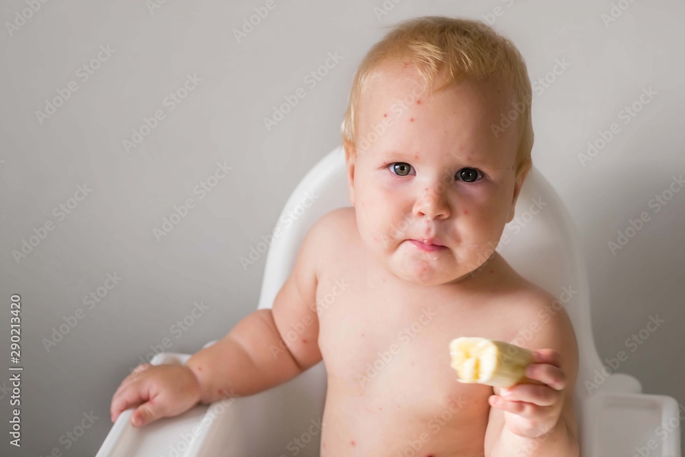 The child is sick with varicella. Measles. The child sits in a feeding chair and eats a banana. Food allergy. No vaccination. The child is sick with varicella. Measles. The child sits in a feeding chair and eats a banana. Food allergy. No vaccination.