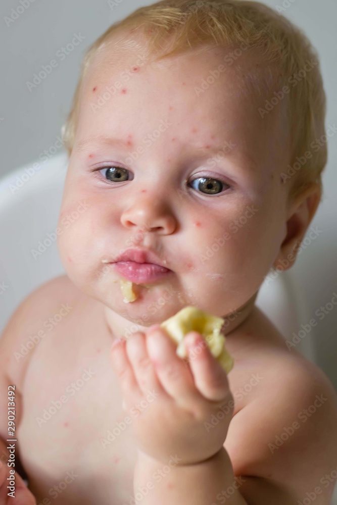 The child is sick with varicella. Measles. The child sits in a feeding chair and eats a banana. Food allergy. No vaccination. The child is sick with varicella. Measles. The child sits in a feeding chair and eats a banana. Food allergy. No vaccination.