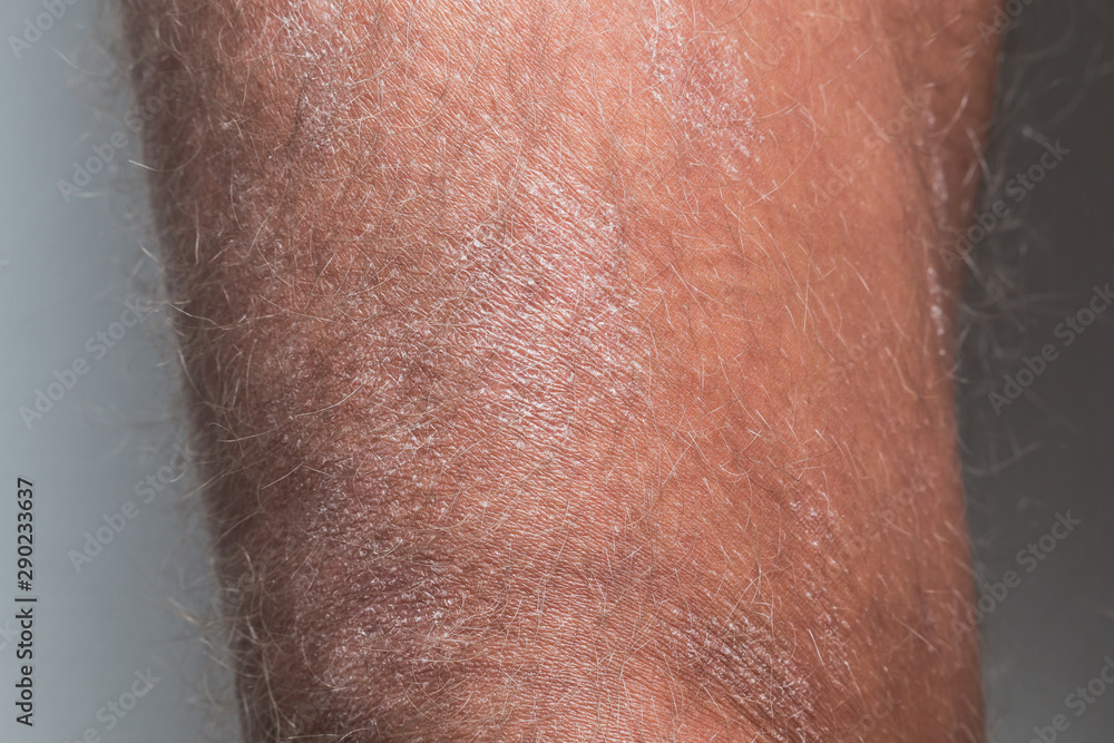 Naklejka premium Large plaque parapsoriasis on caucasian man legs