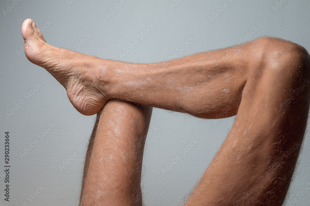 Fototapeta premium Large plaque parapsoriasis on caucasian man legs
