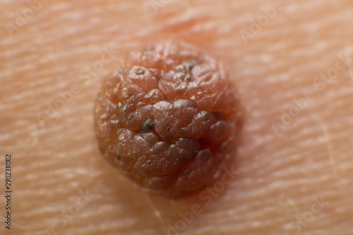 Mole on the skin of the body. Birthmark. Acrochordon
