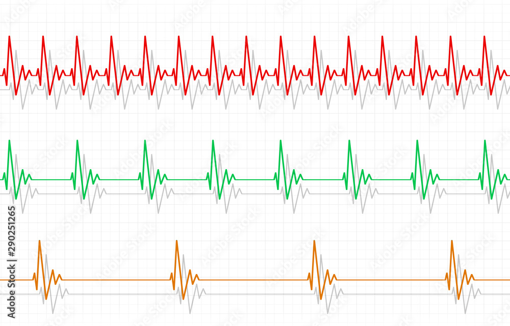 Fast Normal Slow Pulse Fast Normal Slow Pulse