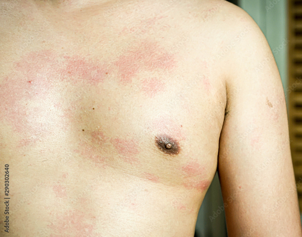 Ringworm on the body, skin infection that's caused by mold. Stock Photo |  Adobe Stock