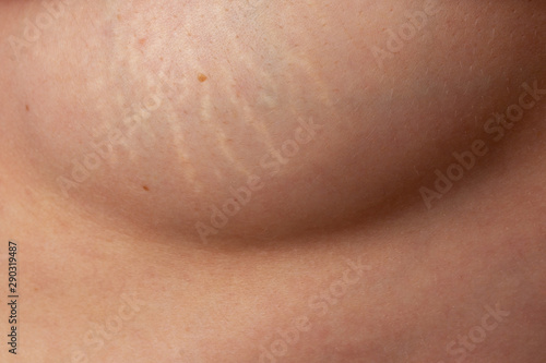 stretch marks on the breast of a young woman after childbirth