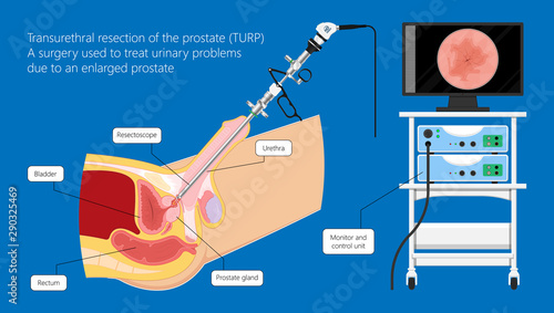 Transurethral resection of the prostate stricture urine bladder digital rectal exam specific antigen Gleason score biopsies Prostatitis test blood ultrasonography Radical Prostatectomy