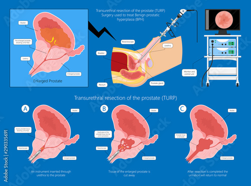 Transurethral resection of the prostate stricture urine bladder digital rectal exam specific antigen Gleason score biopsies Prostatitis test blood ultrasonography Radical Prostatectomy