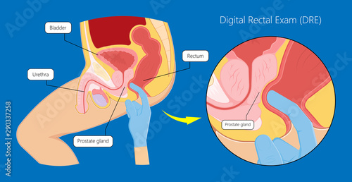 Transurethral resection of the prostate stricture urine bladder digital rectal exam specific antigen Gleason score biopsies Prostatitis test blood ultrasonography Radical Prostatectomy